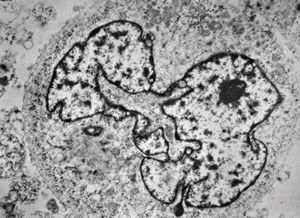 M,5y. | rhabdomyosarcoma vestibuli oris